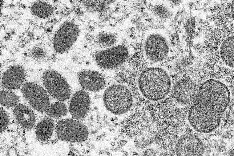ハワイで3例目のサル痘の推定感染者を確認